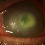 Acanthamoeba clinica