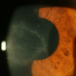 Acanthamoeba clinica