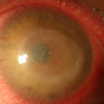 Acanthamoeba clinica